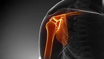  arthroplasty
				(joint replacement)
